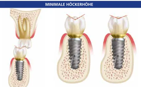 Abb. 2e: Für eine Implantatprothese des Unterkie- Unterkie-fers sollte der bukkale Umriss der Implantatkrone  verringert werden.
