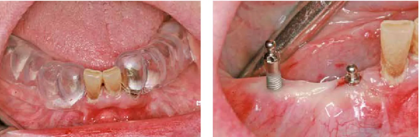 Abb. 11: Tiefziehschiene zum Bestimmen der optimalen Implantatpositionen und transgingivale Insertion der Implantate.
