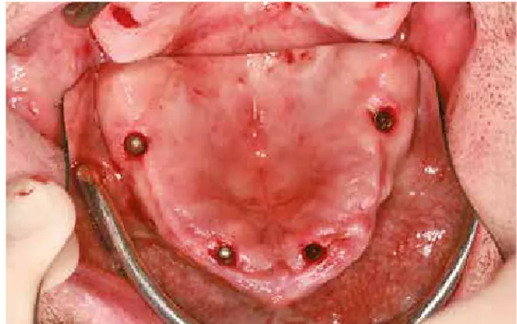 Abb. 16: Hartknochenbohrer. Abb. 17: Klinische Situation der inserierten Implantate im Oberkiefer.