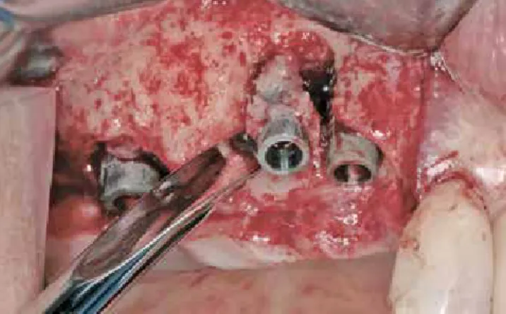 Abb. 7: Die nicht-erhaltungswürdigen Implantate im Oberkiefer links. Abb. 8: Die Explantation der nicht-erhaltungswürdigen Implantate.