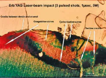 Abb. 4: Histologie eines frisch extrahierten Zahnes, der an der Schmelz-Den- Schmelz-Den-tin-Grenze mit drei Pulsen eines Er:YAG-Lasers bearbeitet wurde (Azan-Färbung)