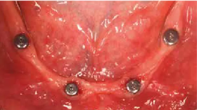 Abb. 6: Komplikationslose Heilung der Implantate 2 Monate  Abb. 9: In die Prothesenbasis eingearbeitete Matrizen für Abb