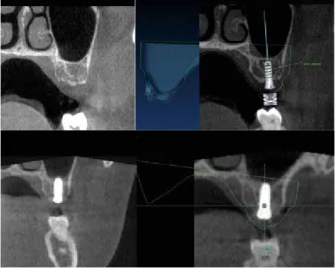 Abb. 6: Ausschnitte eines digitalen Workflows einer navigierten Implantation in regio 27 mit  internem Sinuslift samt postoperativer Ergebniskontrolle der Implantatachse
