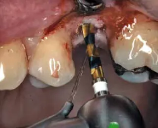 Abb. 5: Aufnahme des Implantats mit dem Implantat- Implantat-Eindreher EV 4,2.