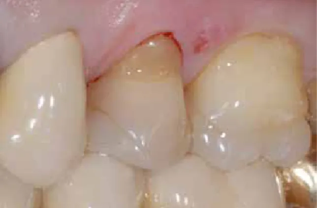 Abb. 1: Zahn 25 hat eine periradikuläre Ostitis nach einer  Wurzellängsfraktur.