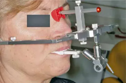 Abb. 16: Die Universalbissgabel kann mittels Adapter in einem Gesichtsbogen  (Girrbach Artex) verwendet werden.