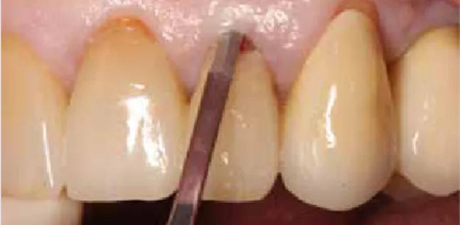 Abb. 2: Verwendung einer Mikroklinge zum Durchtrennen  des Parodonts zur Schonung des Weichgewebes.