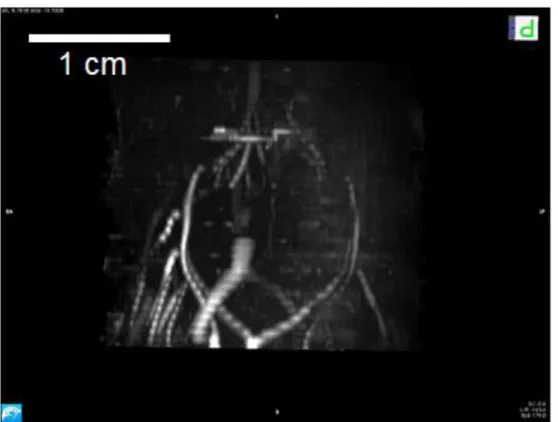 Figure 5-5 3D Angiography MIP in the coronal plane dorsal view.  