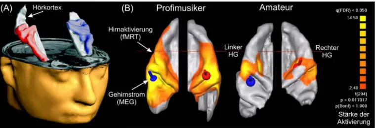 Abb. 2:(A) 3D-Rekonstruktionen des rechten und linken Hörkortex eines Pianisten. (B) Darstellung der fMRT-Aktivität (gelb) und  Lokalisation der im MEG gemessenen auditorisch evozierten Felder (roter und blauer Dipol) eines Profimusikers und eines Amateurs