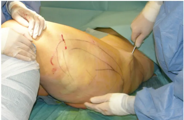 Figure 1 Liposuction procedure after tumescent infiltration at the left outer thigh. The area of  liposuction is marked prior to the operation in accordance with patients request for aesthetic  outcome