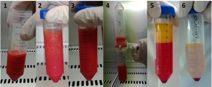 Figure  3  Hand  preparation.  20ml  of  lipoaspirate  (1)  are  mixed  with  equal  volume  of  20ml  DMEM and 2.5-5mg of MNP-S Liberase (2)