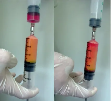 Figure  8  The  collagenase  was  added  to  the  centrifuged  lipoaspirate:  The  upper  syringe  contains DMEM with 10mg of MNP-S Liberase with a volume that is required to obtain 40ml  in the lower syinge containing the lipoaspirate after the first cent
