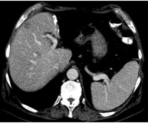 Figure 2  Patient with liver metastases in histological proven liver cir­