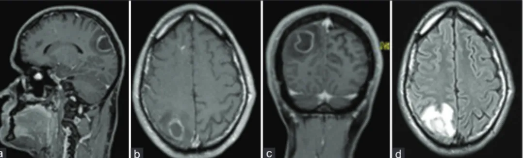 Figure 1:  (a‑c) Contrast‑enhanced T1‑weighted sequences show the brain abscess in the right parietal lobe; (d) diffusion‑weighted magnetic  resonance imaging