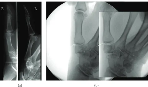Figure 1: (a) Anteroposterior and lateral X-rays of the right TMC joint of a 71-year-old female with OA of the TMC and scaphotrapezio- scaphotrapezio-trapezoid (STT) joints classified as Eaton and Littler III