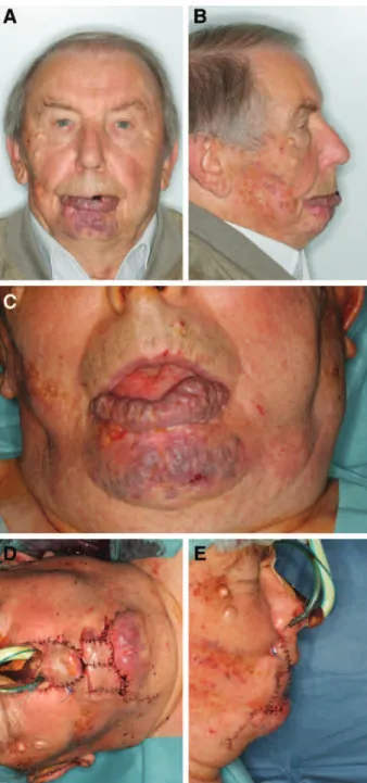 Fig. 5. Postoperative result 1 year after subtotal lower lip  resection and reconstruction by means of double cross-lip  flaps and a Johansons’s step technique (preoperative  photo-graphs in Fig. 4)