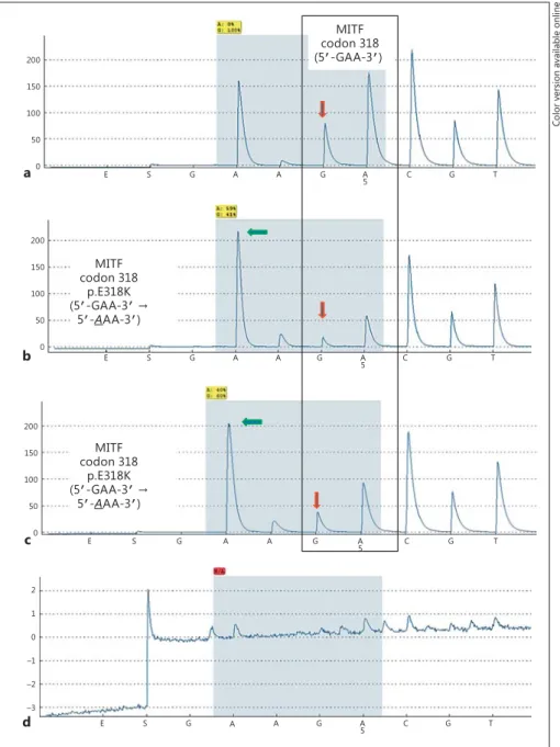 Fig. 1.   Representative examples for pyro- pyro-sequencing analysis (pyrogram) of codon  318 (5  ′ -GAA-3 ′ ) of the MITF gene