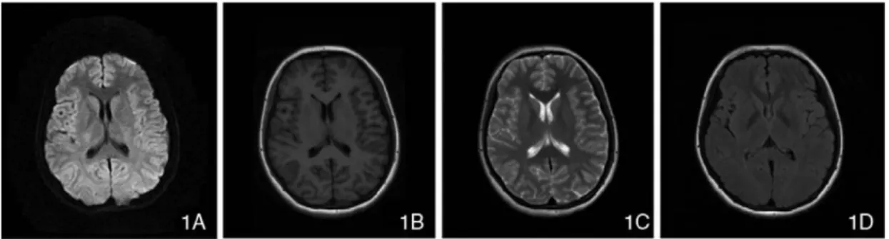 Figure 2.6: Figures 1A-1D represent DWI, T1-weighted, T2-weighted, and FLAIR modalities of MR images.