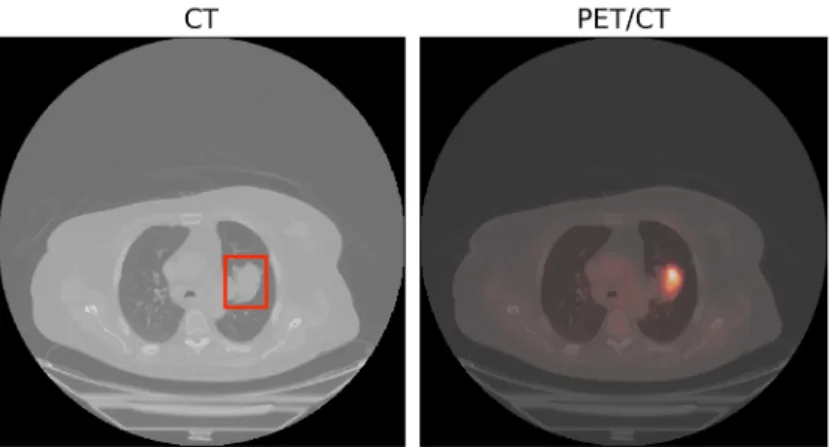 Figure 3.1: (Left) An example of a malignant tumor in the right lung. The tumor is surrounded by the bounding box in red