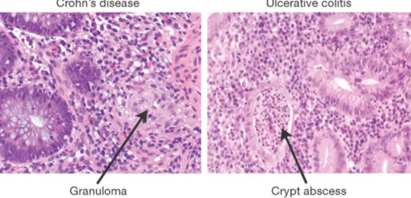Figure 1.1: Histology of Crohn’s Disease and ulcerative colitis. Biopsies of CD and UC active disease