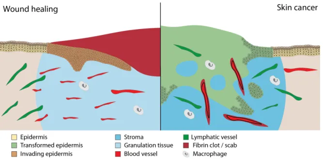 Figure 4: Cellular parallels between a tumor and a skin wound. Schematic representation of  a wound in the phase of new tissue formation 3-10 days after wounding (left) and epithelial  cancer (right)