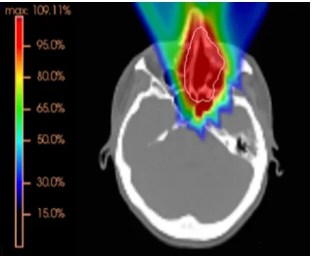 Figure 1.4: Color wash of an optimized dose distribution of a three field plan covering a target (displayed in white) in the nasopharyngeal region