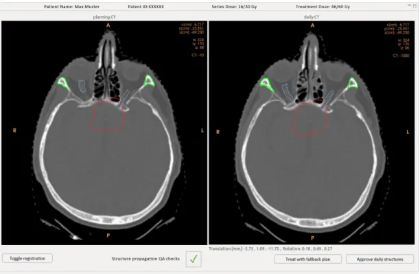 Figure 3.3: Structure propagation check user interface in ADAPT showing the original structures on the planning CT on the left and the propagated structures on the daily CT on the right