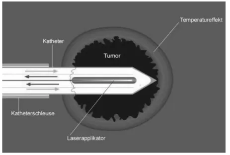Abb. 3.10: Prinzip der Thermotherapie mit Einführung eines wassergekühlten  Laserapplikators in das Tumorgewebe und Darstellung der Randzone.