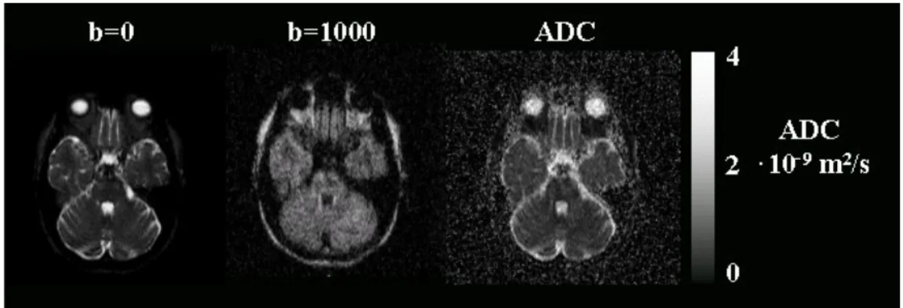 Abb. 4.4: Diffusionsgewichtete Transversalschichten durch den menschlichen  Schädel (SPLICE-HASTE-Sequenz, b=0, und b=1000 s/mm 2 )