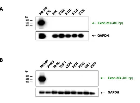 Abbildung 7: RT-PCR-Analyse der APM-1 -Genexpression in Leukozyten-Proben von   Gehirntumor- und Leukämie-Patienten  