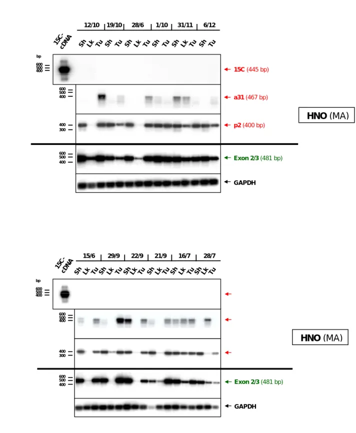 Abbildung 8: RT-PCR-Analyse der APM-1 -Genexpression in Proben von HNO-Tumoren,   Lymphknoten und Schleimhaut 