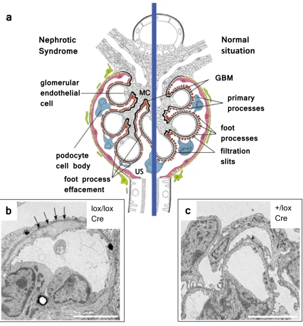 Figure 1.5: (a) The structure of the affected (left) and of the normal (right) glomeru- glomeru-lus