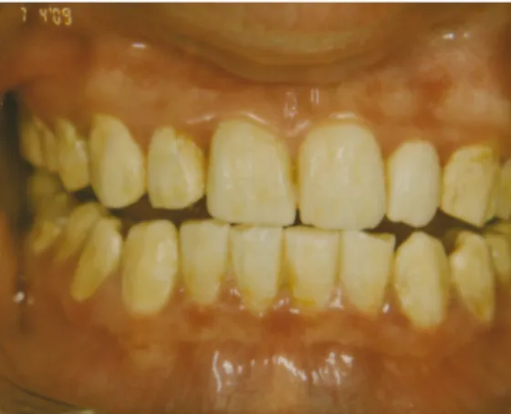 Abbildung 3.1: Nahaufnahme einer hypomaturierten AI bei einer 19-jährigen Patientin, X- X-chromosomal dominanter Erbgang (Quelle: Zahnarztpraxis Dr