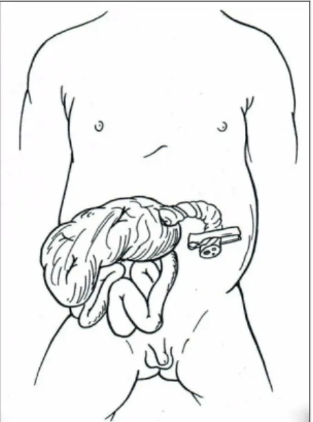 Abbildung 1: Gastroschi sis