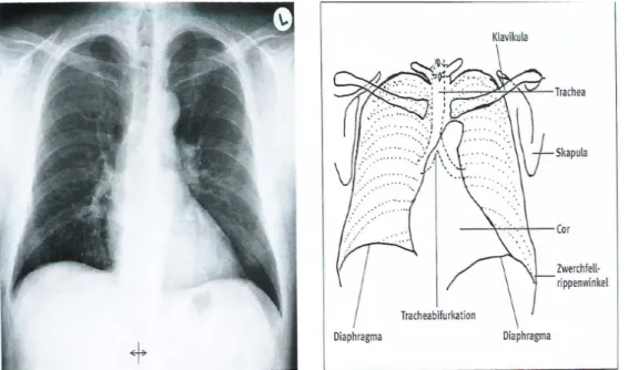 Abb. 4: Röntgenanatomie der konventionellen Thoraxübersichtsaufnahme  [24] 