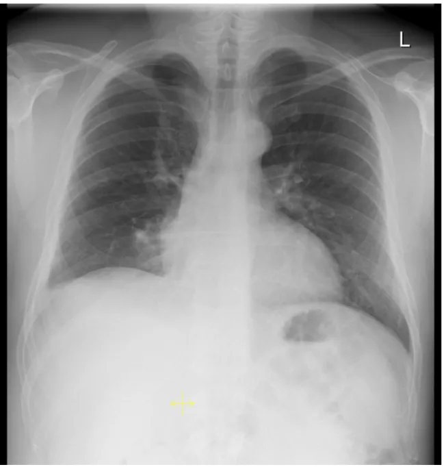 Abb. 7: Pneumothorax rechts apikal  [69]