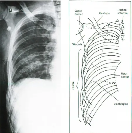 Abb. 8: Röntgenanatomie der Hemithoraxaufnahme  [24] 