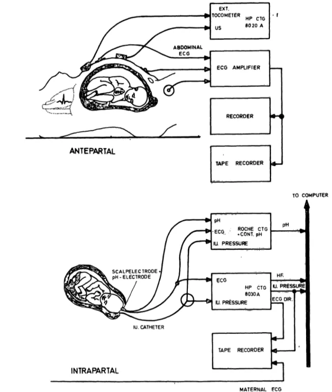 Fig. 7. Schematic representation of the antepartal and intrapartal monitoring of the airhythmia described