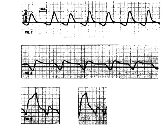 Fig. 7. Time-pressure-curve during spontaneous Ventilation and Fig. 8. Time-pressure-curve during CPAP assisted Ventilation.