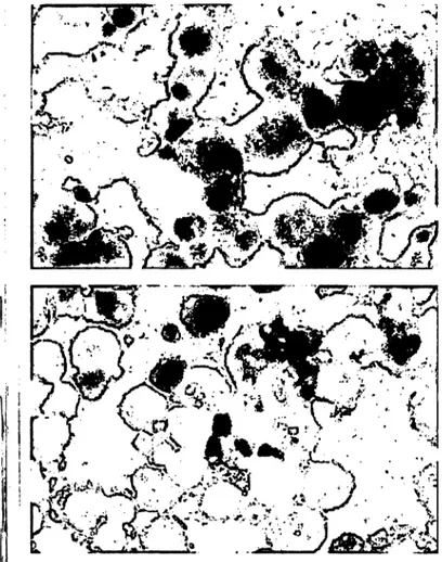Fig. 4 Immunocytochemical staining of cytospin preparations of sarcoid alveolar macrophages (upper panel) and control alveolar macrophages (lower panel) using alkaline phosphatase monoclonal mouse anti-alkaline phosphatase complex (magnification: 400 X).
