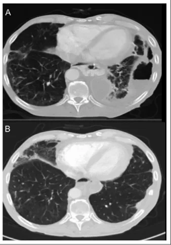 Figure 2.  Chest CT scan of pleural empyema before (A) and  after (B) Mini-VAC-instill therapy