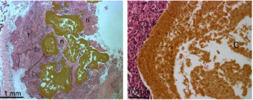 Figure 3. Photomicrographs (right: 25×, left: 200×) of Swiss nude mice subcutaneous  xenografts Co112 injected with an EVAL-based formulation incorporating 40% w/v of  magnetic nanoparticles