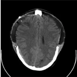 Figure 1: Initial CT-scan with generalized brain edema Figure 2: Postoperative CT-scan demonstrating adequate bilateral decompression
