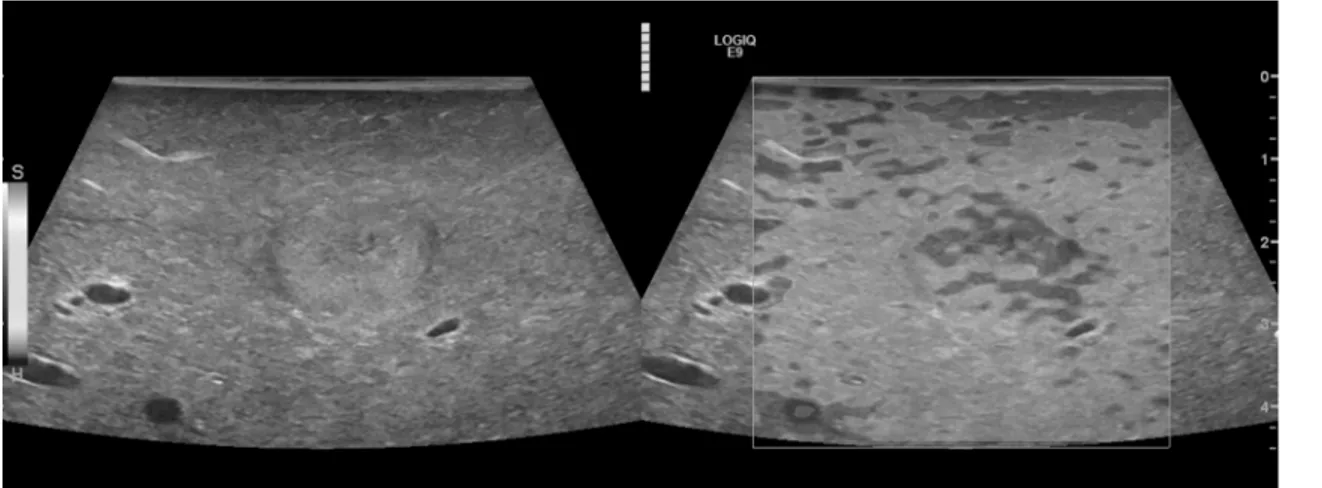 Fig 3. Intraoperative B-mode and strain elastography (SE) in a case of metastatic breast carcinoma