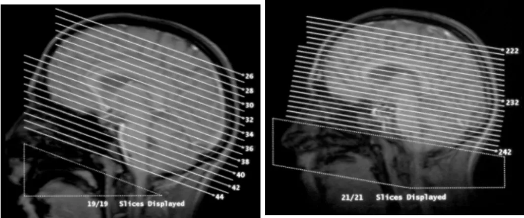 Abb. 3-1: links: Topogramm aus der Akutphase der Enzephalitis rechts: näherungsweise identische Schichtorientierung bei der Nachuntersuchung (man beachte die unterschiedlich starke Reklination des Kopfes)