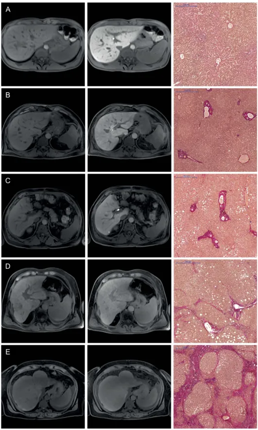 Figure 1.  Images comparing the plain and hepatobiliary phases T1-weighted VIBE sequence with fat  suppression for the non-contrast (1 st  column) and hepatobiliary phase (2 nd  column) of a patient with  normal liver parenchyma (A) and for patients with d