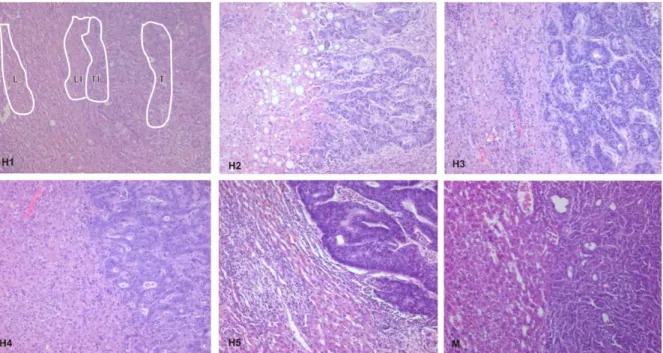 Figure 4 : Histology of invasion fronts of liver metastases from the clinical  specimen and from the murine model