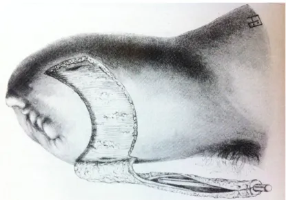Abbildung 13: Figur 70. Bildung des gestielten Hautlappens und seine Umformung zu einem Schlauch&#34;,  welcher dem „Hautkanal“ entspricht