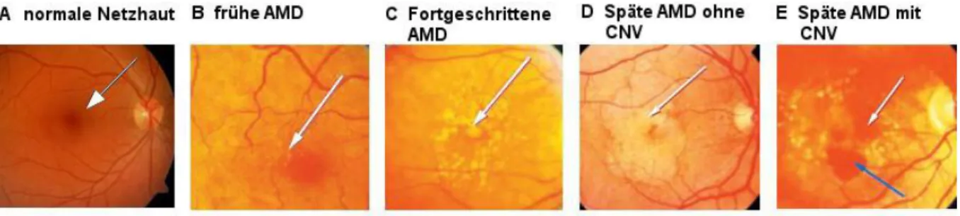 Abbildung  4:  Typische  funduskopische  Befunde der AMD erzeugt  mit einer Funduskamera:  A  zeigt  eine  normale Netzhaut (Pfeil zeigt auf die Fovea); B zeigt eine Frühphase der AMD mit wenigen Drusen (Pfeil); 