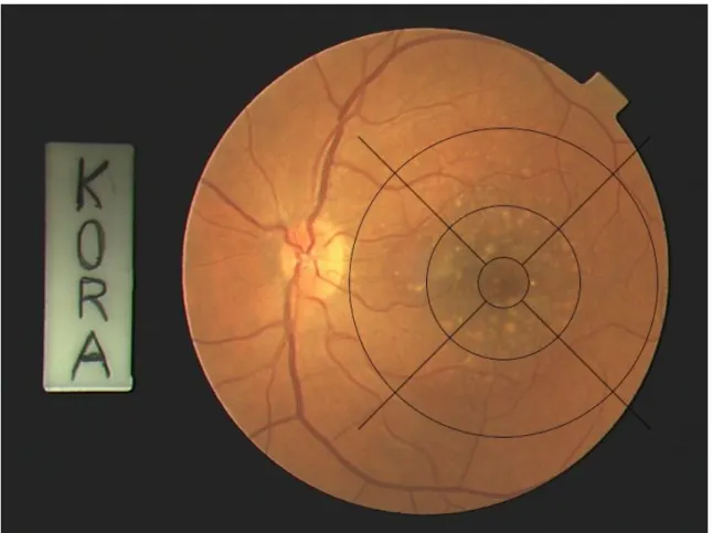 Abbildung  7:  Zentrales  Farbfundusfoto  des  linken  Auges  mit  digital  implementiertem,  adaptiertem  Grid  und deutlich sichtbaren Drusen 